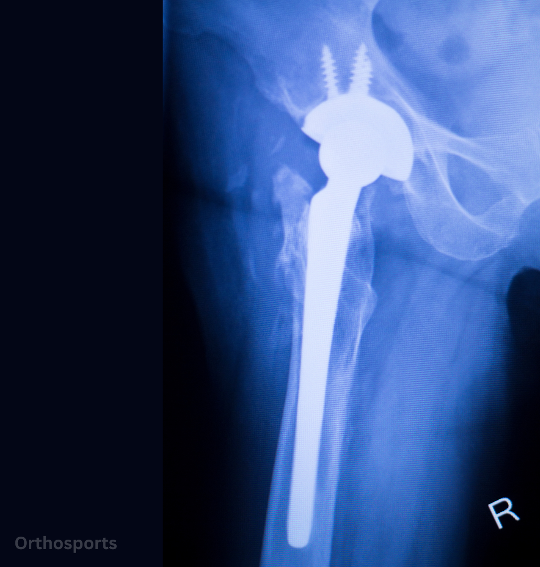 The image shows the components of a hip replacement implant and how it integrates with the hip joint
