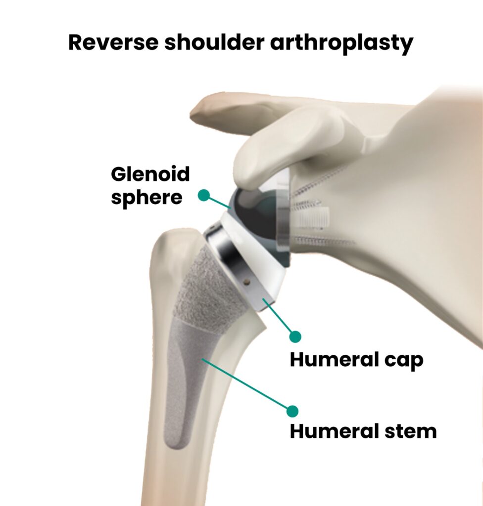 An image of reverse shoulder arthroplasty showing the components of the implant. The labeled parts include the glenoid sphere, which replaces the socket, the humeral cap, which fits into the sphere, and the humeral stem, which is inserted into the humerus bone for stability. The image demonstrates how these parts work together in a reverse shoulder replacement procedure.