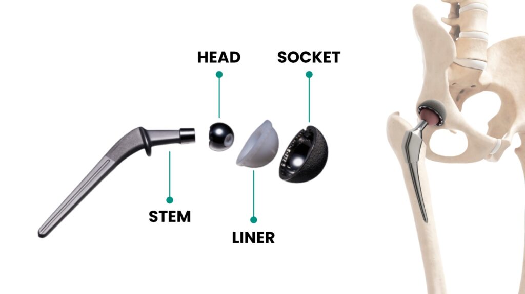 The image shows the components of a hip replacement implant and how it integrates with the hip joint. The labeled parts include the stem, which is inserted into the femur; the head, which replaces the ball of the hip joint; the liner, which provides cushioning; and the socket, which replaces the hip's natural socket. To the right, there is a diagram of a pelvis with the implant positioned within the hip joint, demonstrating its placement and function.